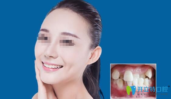 重慶牙科哪家正畸好點？來看華美口腔牙齒不齊歪斜矯正案例