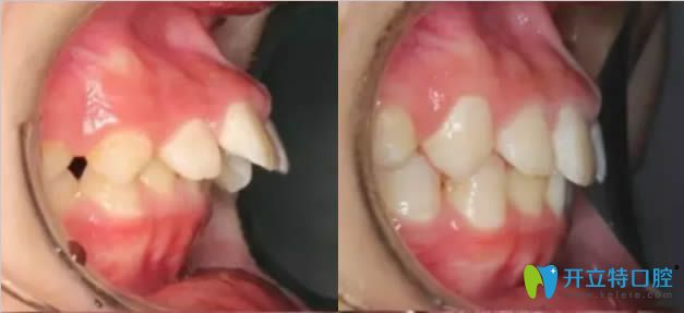 mrc矯正深覆合側(cè)顏前后對比圖