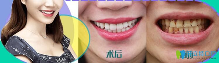 瓷貼面做了后悔死了，后悔沒有早點選擇華美牙科修復(fù)我的四環(huán)素牙