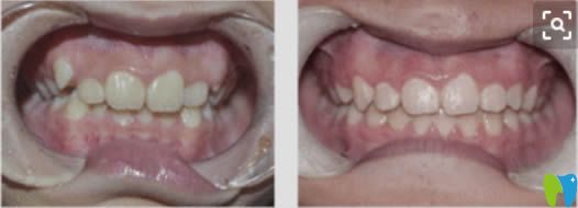 周驊醫(yī)生成人時(shí)代天使隱形矯正前后對比效果