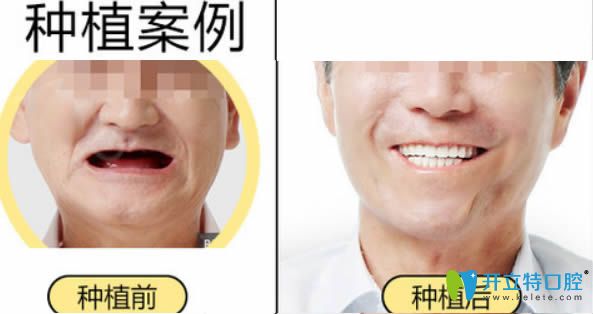 <!--<i data=20240703-sp></i>-->宏康李敬主任全口種植牙前后對比效果圖
