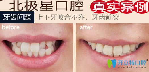 無錫北極星口腔牙齒正畸案例效果對(duì)比圖