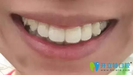 我在北京美萊整形口腔科做牙齒矯正第9個(gè)月