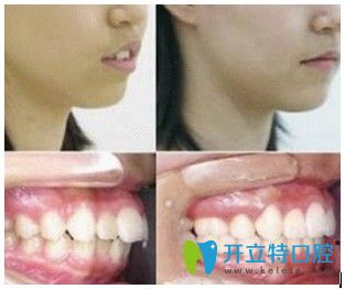 北京美萊口腔宋學(xué)志主任齙牙矯正前后對比圖