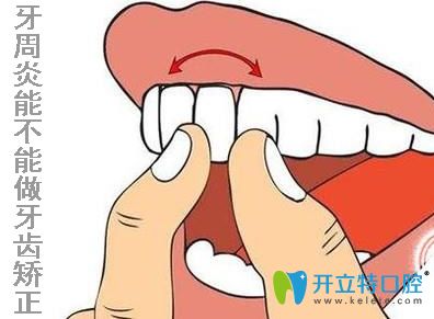 牙周炎能不能做牙齒矯正