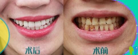 重慶華美牙科靠譜嗎？苗智許超薄瓷貼面修復(fù)牙齒案例對比效果公布