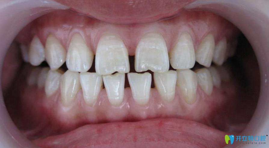 牙周炎醫(yī)生不建議整牙是真的嗎