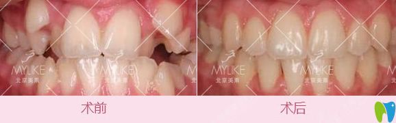 北京美萊口腔虎牙隱形矯正前后對比圖