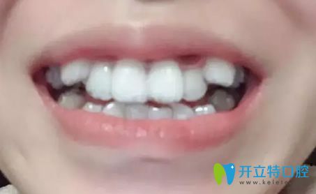 我在北京美萊做隱形牙齒矯正第3個(gè)月