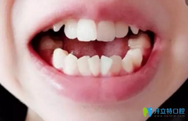 在漢中小白象做陶瓷半隱形矯正已117天了,附正畸價格及結(jié)果