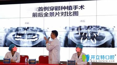 穿顴種植是什么?杭州美奧王明講解穿顴骨種植的利弊