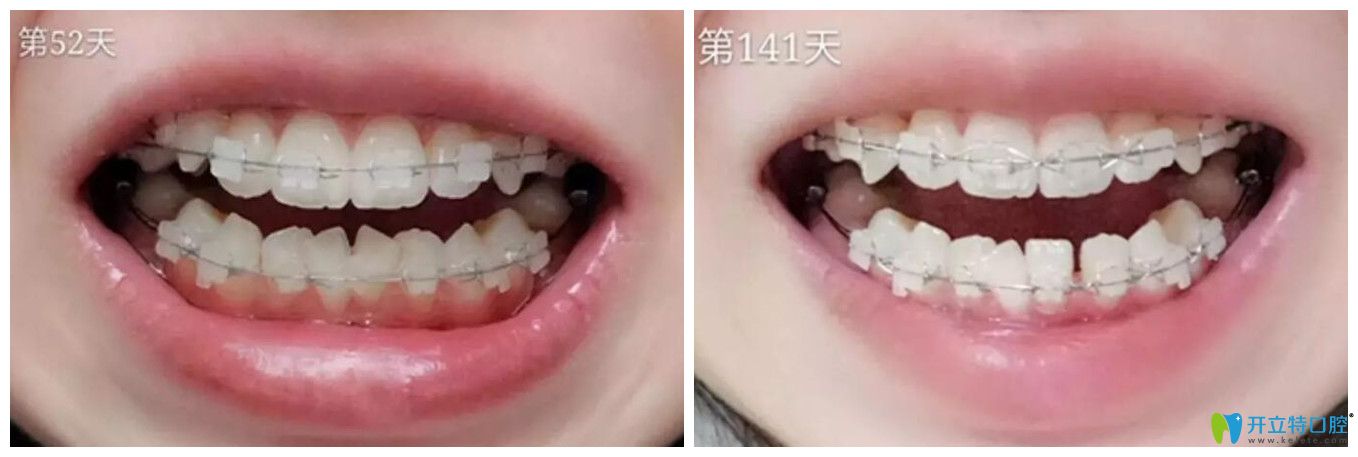 小白象口腔半隱形矯正52天和141天對(duì)比圖
