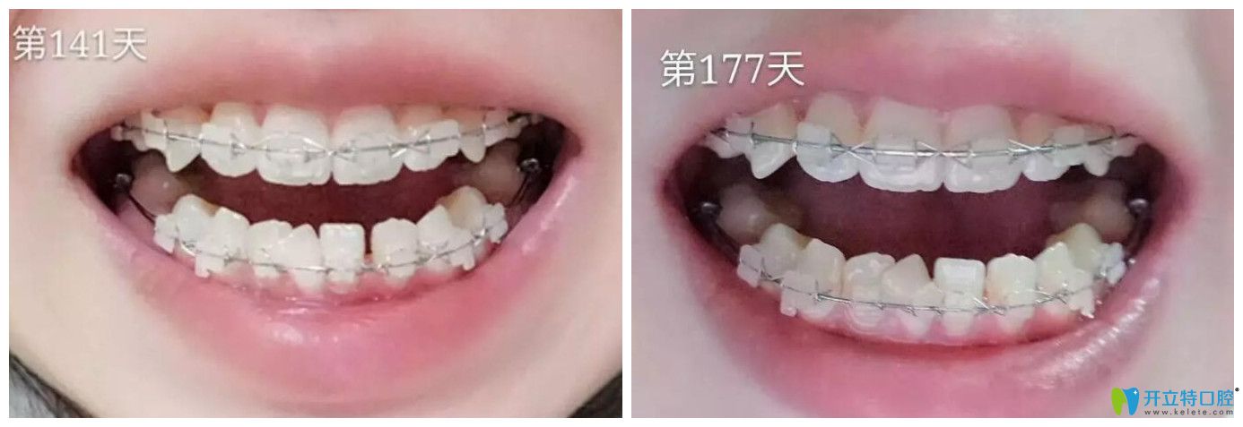 屬于漢中小白象口腔牙齒矯正141天和177天對(duì)比<span style=