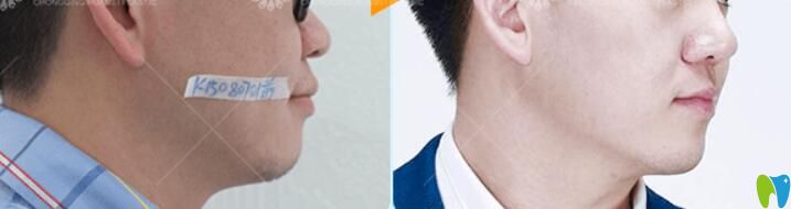 重慶牙齒矯正哪里好？重慶華美口腔吳承瓊牙齒半隱形矯正案例公布