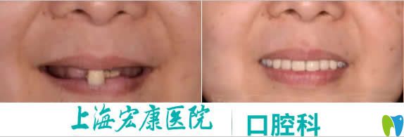 <!--<i data=20240703-sp></i>-->宏康口腔科67歲老人全口種植牙前后對比效果