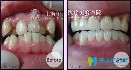 <!--<i data=20240703-sp></i>-->伊萊美王海鑫醫(yī)生虎牙矯正前后對比照