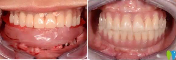 做完全口種植牙后的即可效果