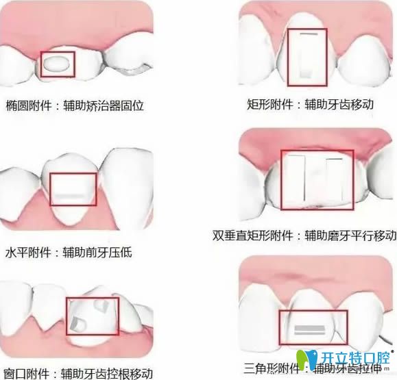 隱形牙套附件不同種類的相對(duì)作用示意圖
