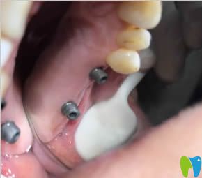 我在太原眾牙口腔做種植牙的術(shù)中照