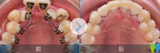 伊萊美口腔李真旼博士舌側(cè)矯正前后對比效果圖