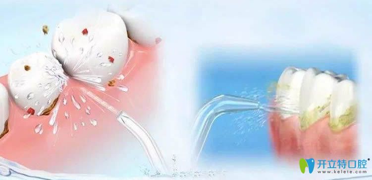 網(wǎng)傳洗牙后我得了艾滋病,都千萬(wàn)別洗牙,揭秘洗牙的利弊真相