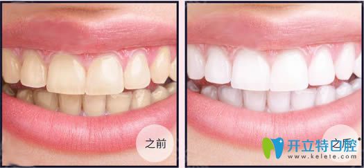 <!--<i data=20240703-sp></i>-->伊萊美王海金超聲波洗牙前后對比圖