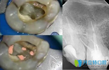 活髓切斷術(shù)和根管治療的區(qū)別對比圖