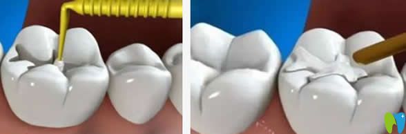 補(bǔ)牙會越補(bǔ)越爛嗎