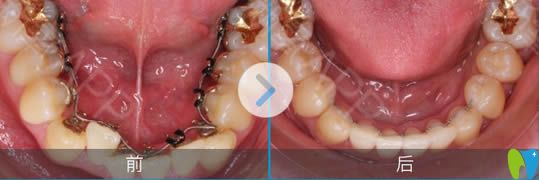 舌側矯正下頜牙前后對比照