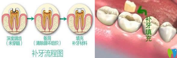 有關(guān)補(bǔ)牙會(huì)不會(huì)越補(bǔ)越爛和千萬不要去補(bǔ)牙的真相大揭秘