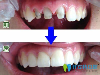 臺州維多利亞口腔于文學主任美容冠修復效果對比圖