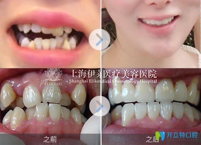 虎牙選擇隱適美隱形矯正前后對比照 虎牙選擇隱適美隱形矯正前后對比照