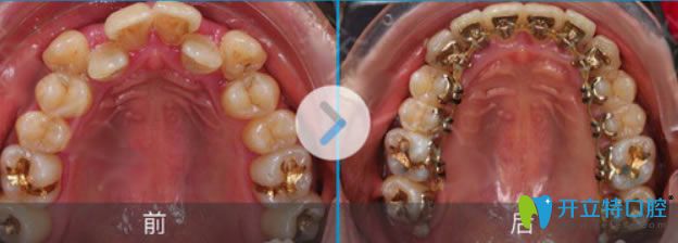 <!--<i data=20240703-sp></i>-->伊萊美舌側隱形矯正齙牙前后對比圖 <!--<i data=20240703-sp></i>-->伊萊美舌側隱形矯正齙牙前后對比圖