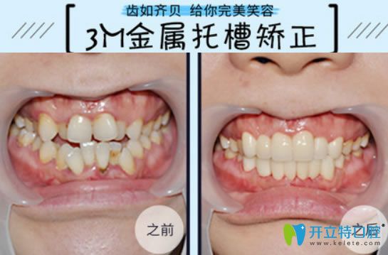 牙齒擁擠選擇3m金屬托槽矯正前后對比效果 牙齒擁擠選擇3m金屬托槽矯正前后對比效果