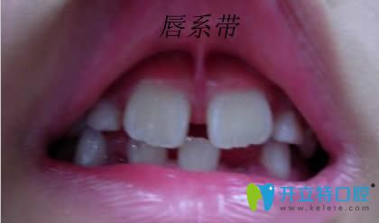 上唇系帶修整術(shù)是什么？唇系帶斷了修復(fù)時(shí)間是何時(shí)