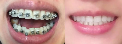24歲正畸不算晚，聊聊我在西安畫(huà)美口腔做牙齒矯正那些事