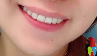 我在臺州維多利亞戴隱形牙套術(shù)后效果圖 我在臺州維多利亞戴隱形牙套術(shù)后效果圖