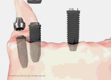 Allon4種植技術(shù)圖解