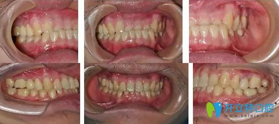 北京京通口腔李夢(mèng)華醫(yī)生反頜矯正案例