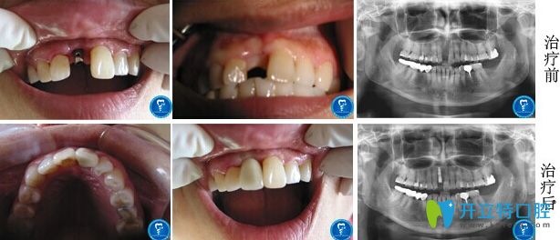 北京京通口腔單顆牙缺失即刻種植案例