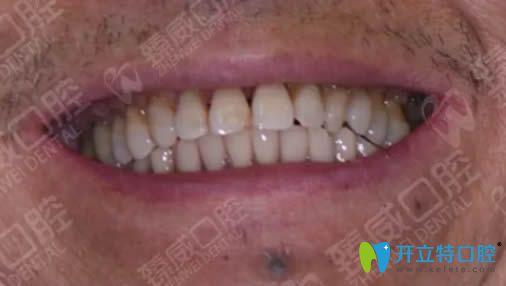 在<!--<i data=20240703-sp></i>-->臻威做完allon4即刻種植牙后的效果