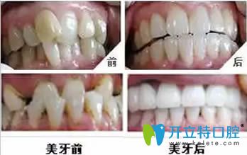 鄭杰星醫(yī)生牙齒正畸效果對比圖