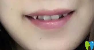 在臺(tái)州維多利亞口腔戴隱形牙套一年半了 來個(gè)前后對(duì)比效果