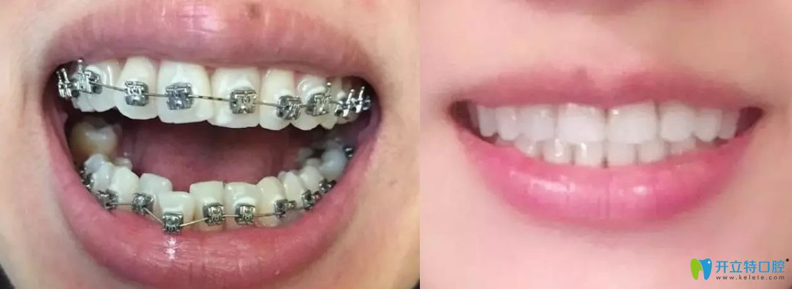 牙齒矯正前后對比圖