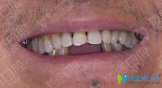 上海臻威口腔allon4種植牙真實案例 講述我種植牙1年后的感受