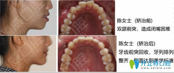 <!--<i data=20240703-sp></i>-->臻威口腔魏東醫(yī)生隱適美齙牙矯正前后對(duì)比照