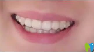 時代天使隱形矯正1年效果 時代天使隱形矯正1年效果