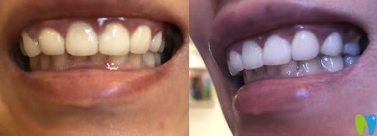 黃仁輝牙貼面美容效果對(duì)比圖