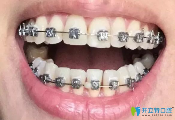 牙齒矯正第100天