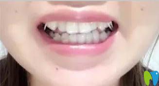 我在臺州維多利亞口腔做戴隱形牙套17副時效果圖 我在臺州維多利亞口腔做戴隱形牙套17副時效果圖